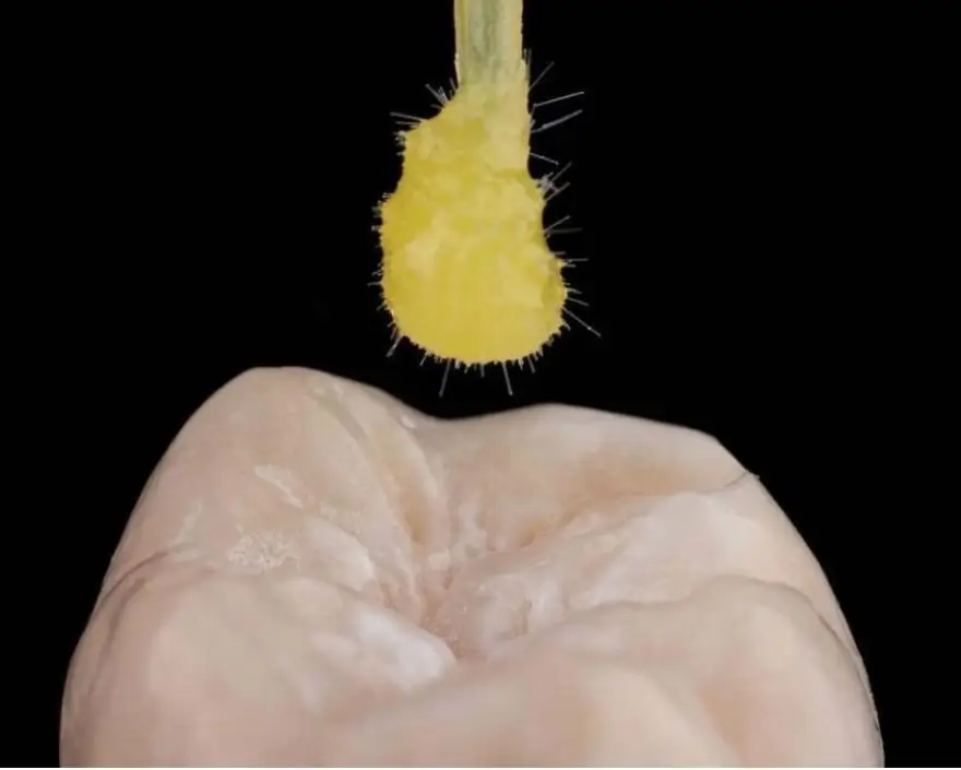 Dental Sealants Dental Sealants